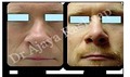 Rhinoplasty Nose Surgery Manufacturer Supplier Wholesale Exporter Importer Buyer Trader Retailer in New Delhi Delhi India